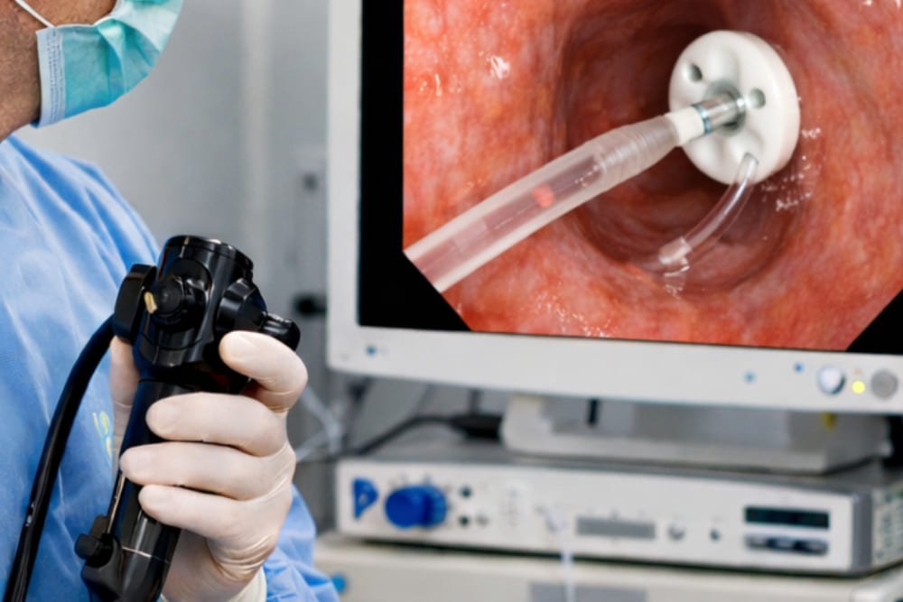 Colocación endoscópica de sondas para alimentación en CDMX: soporte nutricional seguro y especializado