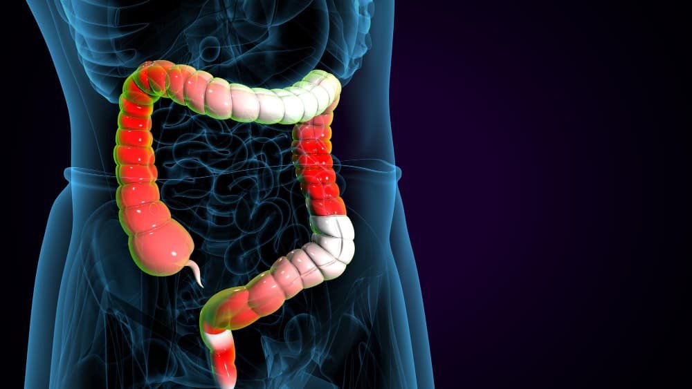 Dilatación de estenosis gastrointestinales en CDMX: tratamiento endoscópico para mejorar el paso digestivo